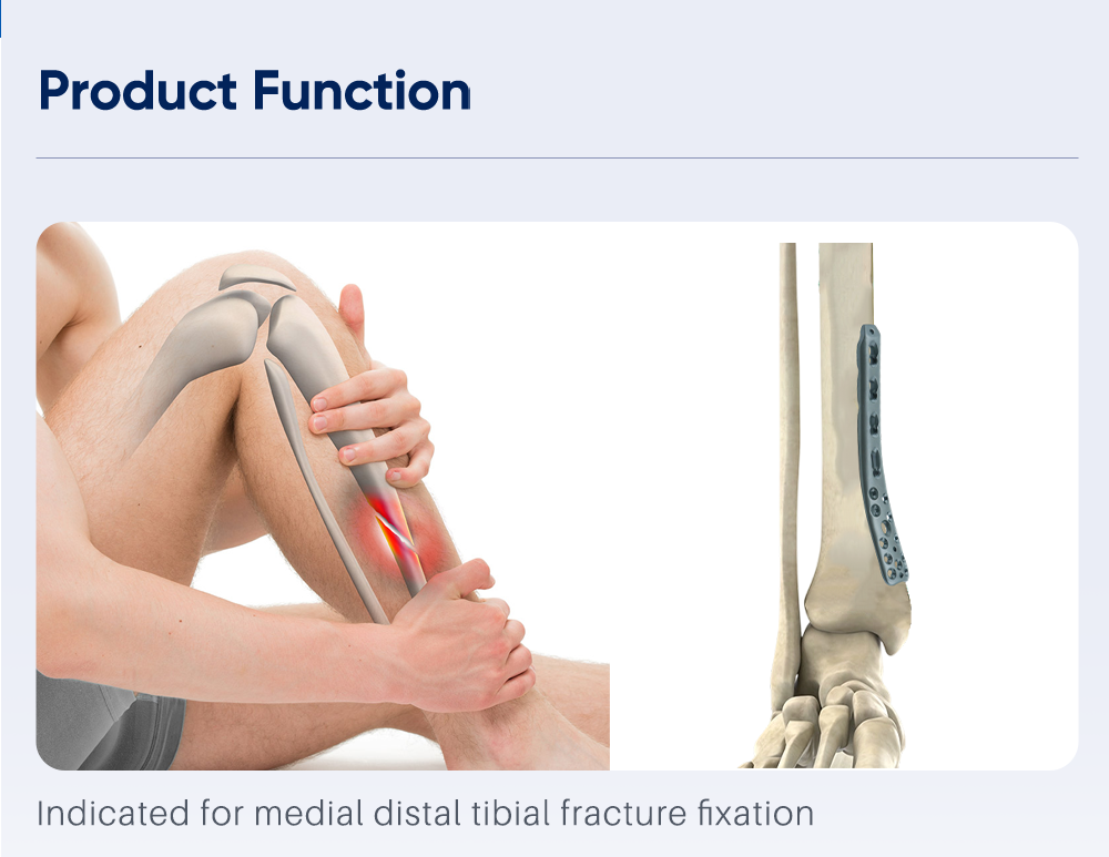 Medial Polyaxial Plate for Distal Tibia - Buy Product on XC Medico ڊسٽل ٽبيا لاءِ وچولي پوليڪسيل پليٽ - ايڪس سي ميڊيڪو تي پراڊڪٽ خريد ڪريو