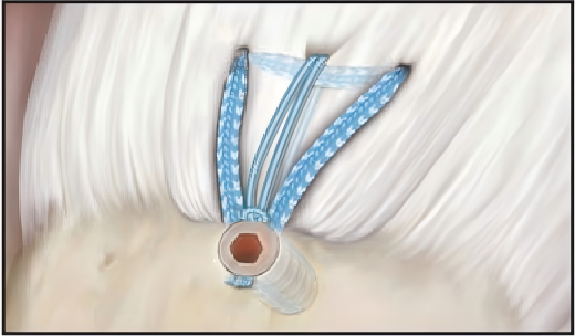 Suture tape in rotator cuff repair Varrószalag a forgómandzsetta javításában
