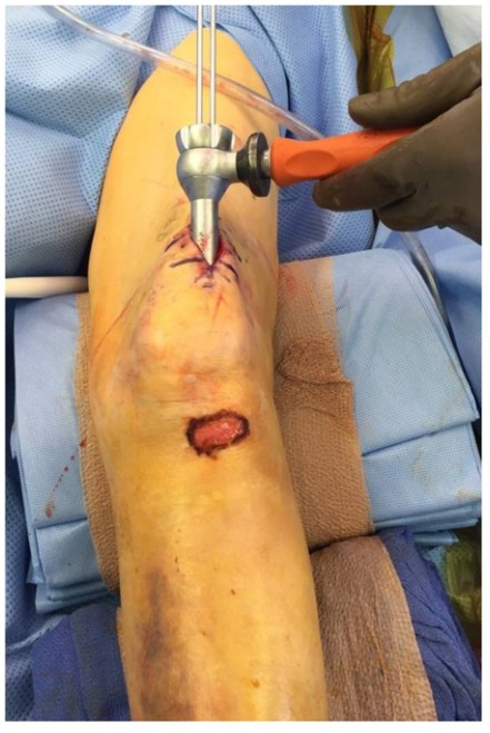 Tibial Intramedullary Nail Fixation Technique-4 Tècnica de fixació de l'ungla intramedul·lar tibial-4