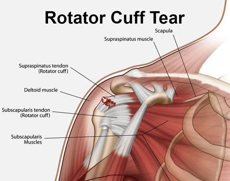 rotator-cuff-tear-maliit