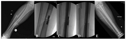 Tibial Intramedullary Nail Fixation Technique-8 Tècnica de fixació de l'ungla intramedul·lar tibial-8