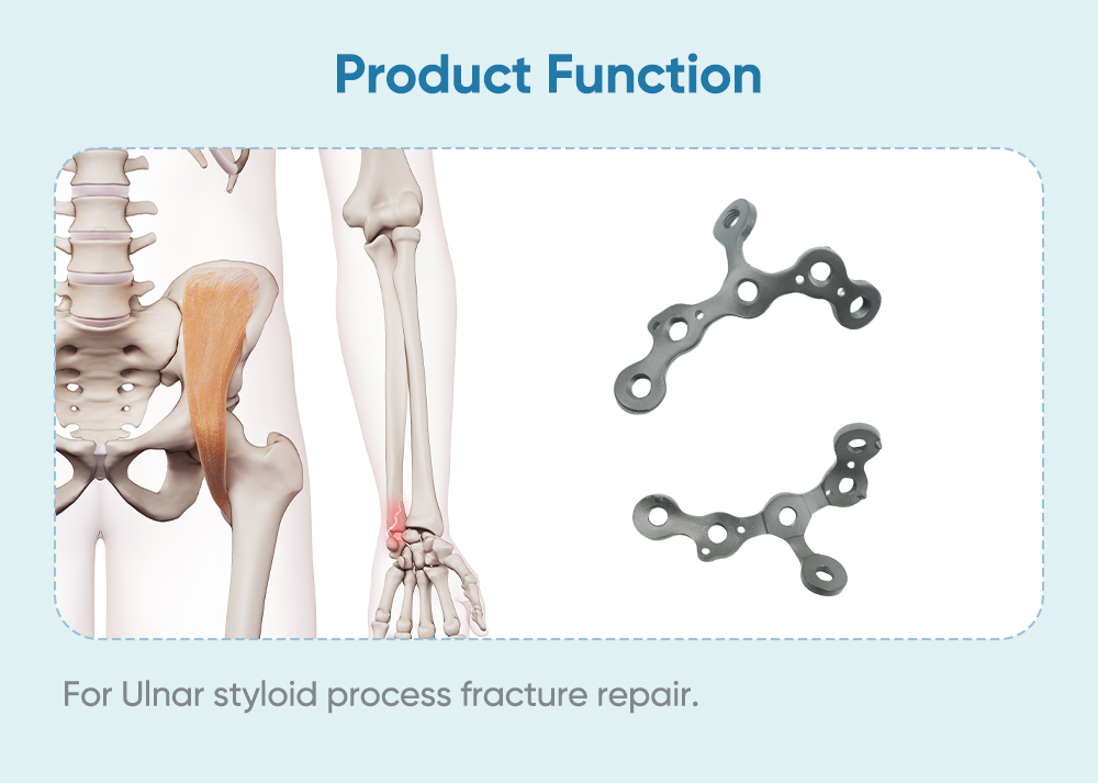 Locking Plate for Ulnar Styloid Process II - Buy Product on XC Medico Placă de blocare pentru Procesul Stiloid Ulnar II - Cumpărați produs pe XC Medico