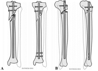 Tibial Intramedullary Nail Fixation Technique-9 Tècnica de fixació de l'ungla intramedul·lar tibial-9