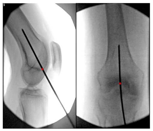 Femoral Intramedullary Nailing - How To Choose The Best Insertion Point-5 Femoral Intramedullary Nailing - Paano Pumili Ang Pinakamahusay na Insertion Point-5