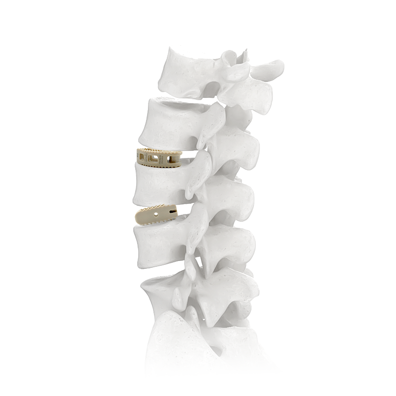 Ключови свойства на PEEK Spinal Cage