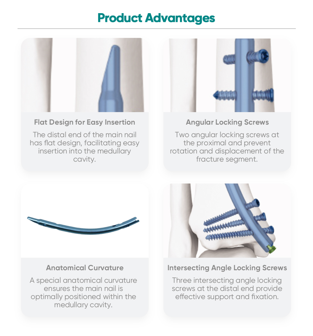 Дистален тибиален нокът | Ретроградна интрамедуларна фиксираща система | XC Medico Orthopedics