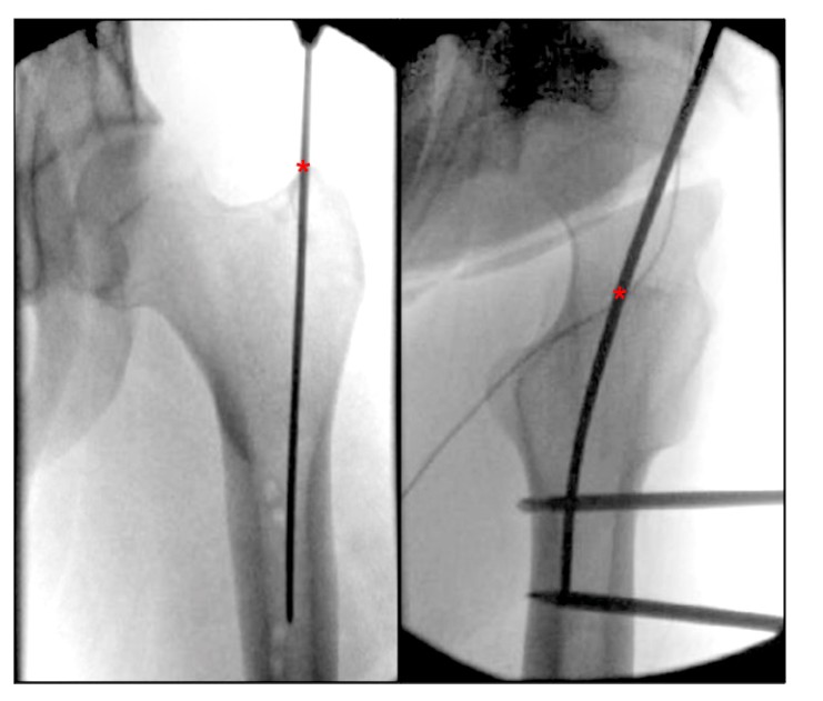 Femoral Intramedullary Nailing - How To Choose The Best Insertion Point-3 Femoral Intramedullary Nailing - Paano Pumili Ang Pinakamahusay na Insertion Point-3