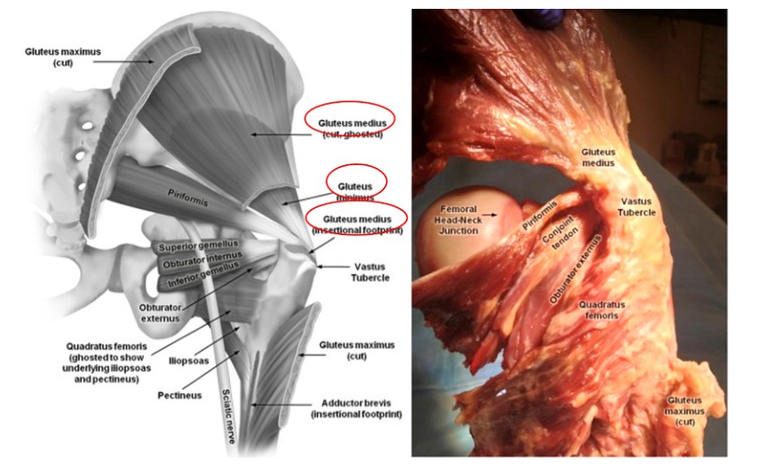 Femoral Intramedullary Nailing - How To Choose The Best Insertion Point-1 Femoral Intramedullary Nailing - Paano Pumili Ang Pinakamagandang Insertion Point-1