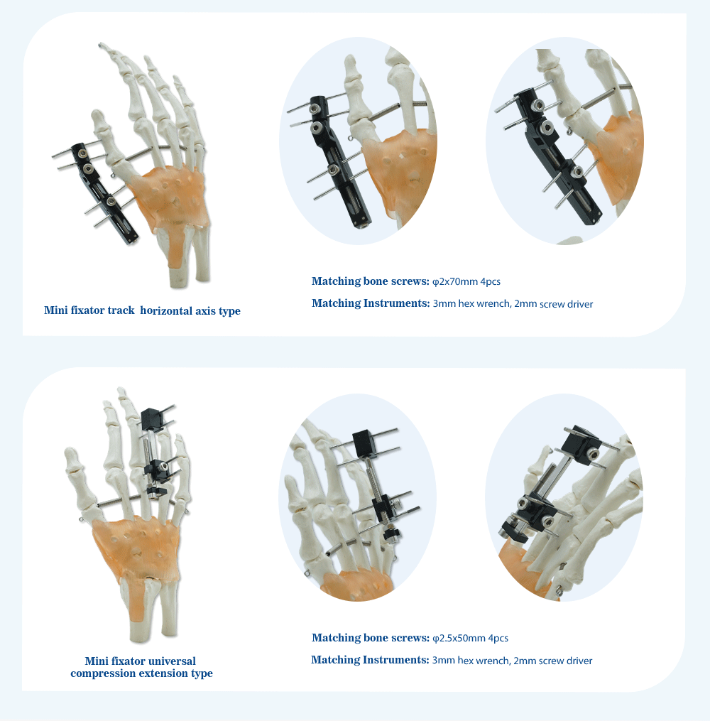 External Fixation Ntawm Metacarpals Thiab Phalanges - Duab 4