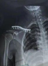 Διάγνωση και θεραπεία κατάγματος κλείδας-25