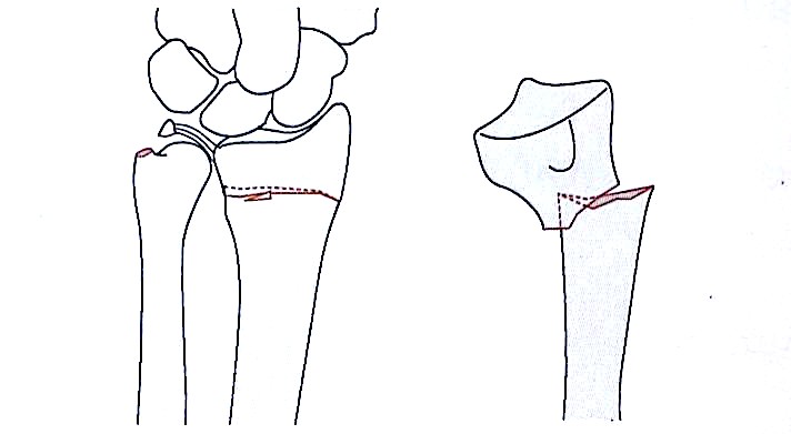 Zlomi distalnega radiusa-3