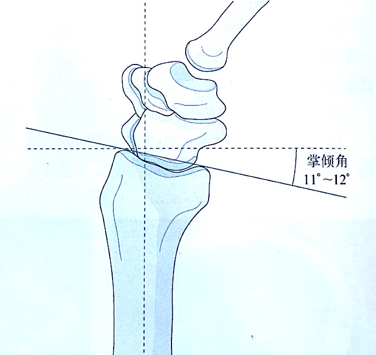 Zlomi distalnega radiusa-2