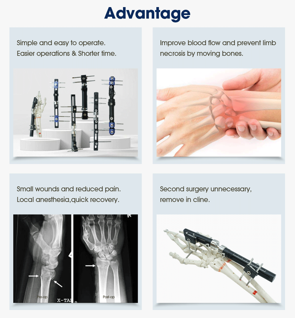 Fixator Ita Ọwọ - Ra ọja lori XC Medico