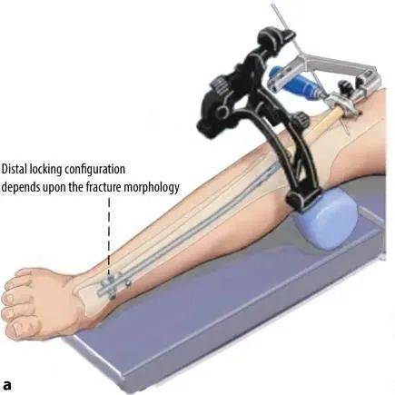fractures tibial, suprapatellar intramedullary t&eacute;hnik kuku-18