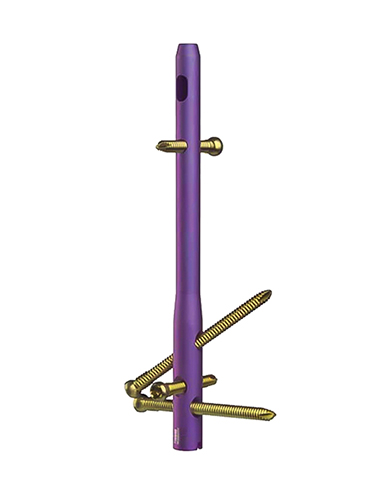 Intramedulláris köröm