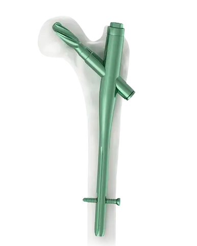 Intramedulláris köröm