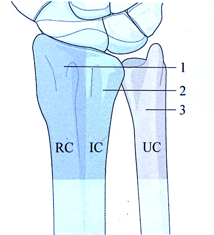 Zlomi distalnega radiusa