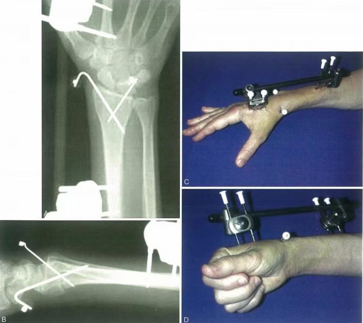Zlomi distalnega radiusa-11
