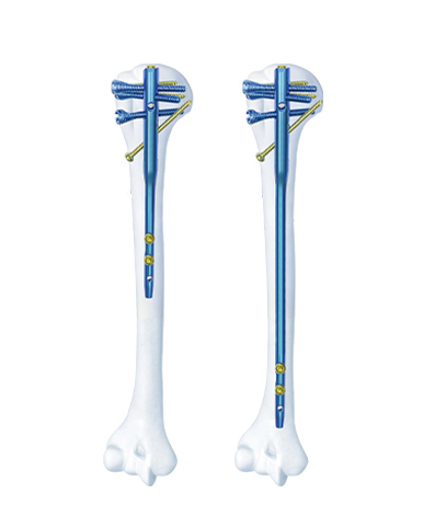 Intramedulláris köröm