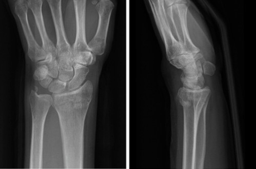 Zlomi distalnega radiusa-12