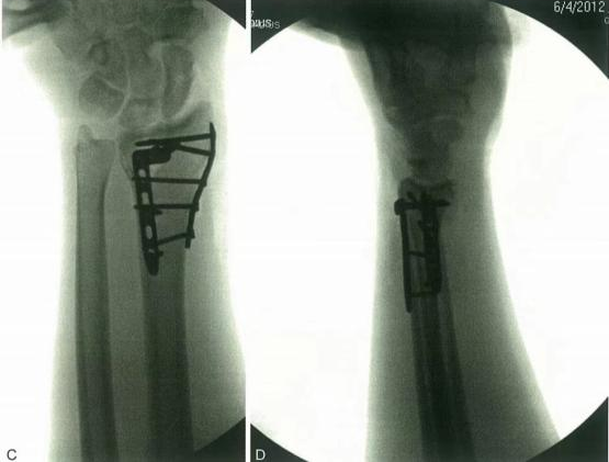 Zlomi distalnega radiusa-23