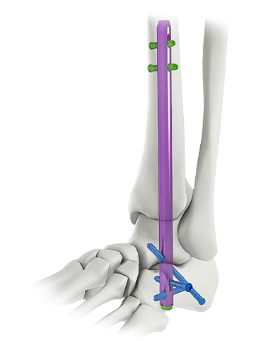 Intramedulláris köröm