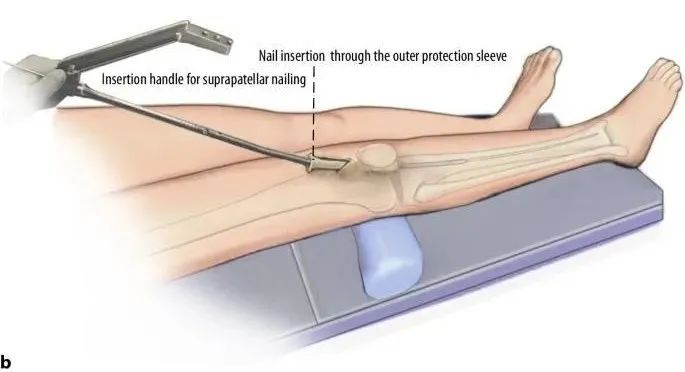 fraktur tibial, suprapatellar intramedullary t&eacute;hnik kuku-17