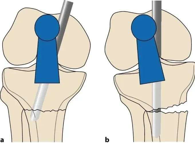 fraktur tibial, suprapatellar intramedullary t&eacute;hnik kuku-1