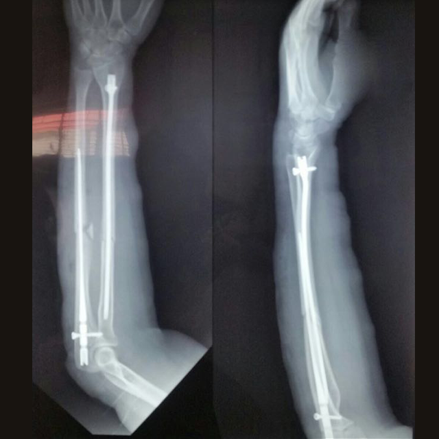 รัศมีและกระดูกท่อน