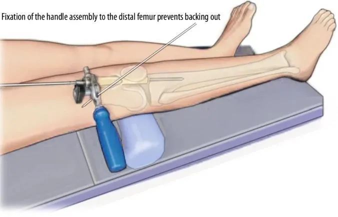 fraktur tibial, suprapatellar intramedullary t&eacute;hnik kuku-12