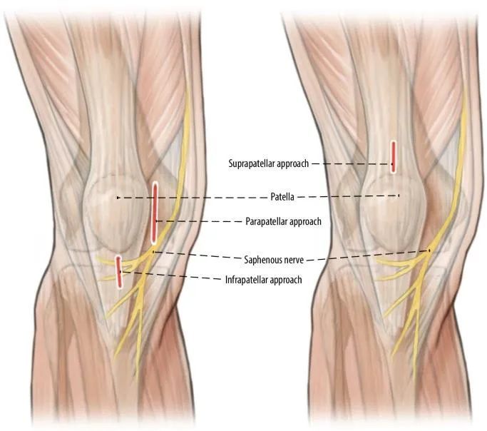 fraktur tibial, suprapatellar intramedullary t&eacute;hnik kuku-3