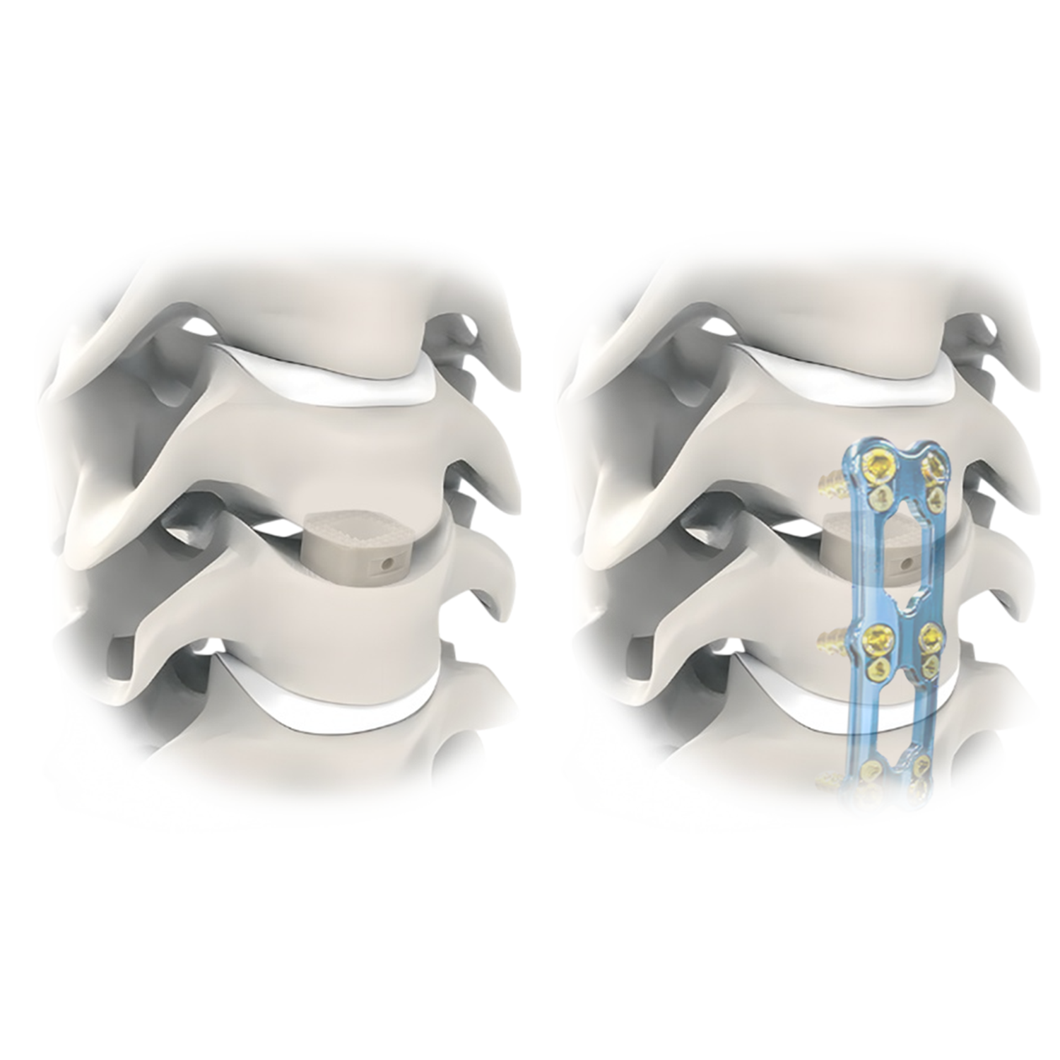 PEEK jaula cervical llamk’achisqa &ntilde;awpaq cervical intercuerpo fusi&oacute;n kaqpaq