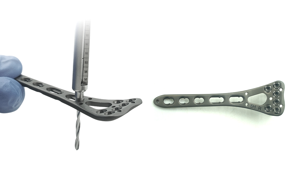 Premium Titanium Alloy ແລະ CNC Machining ສໍາລັບ Orthopedic Radius Implants